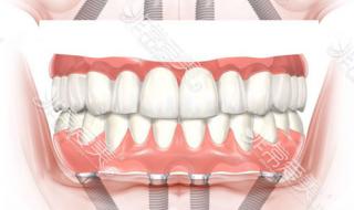 种植牙报价 种植牙报价